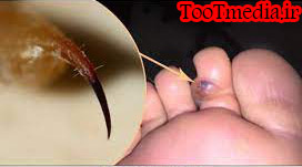 عقرب گزیدگی